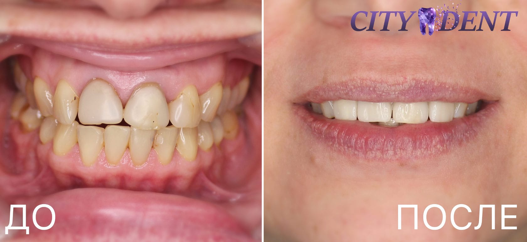Улыбка до и после реставрации зубов винирами