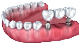 Схема имплантации зубов