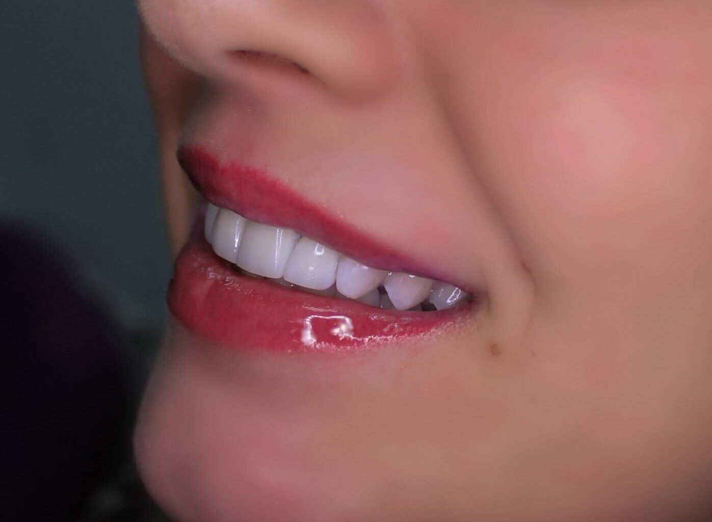 Эстетическая реставрация зубов, зубы после установки винир из диоксида циркония