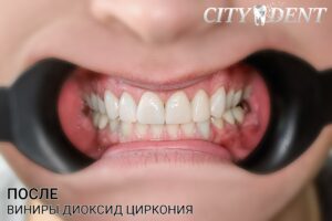 Эстетическая реставрация зубов: рассмотрение возможностей протезирования для улучшения эстетики улыбки, включая виниры, протезирование передних зубов и использование эстетических материалов