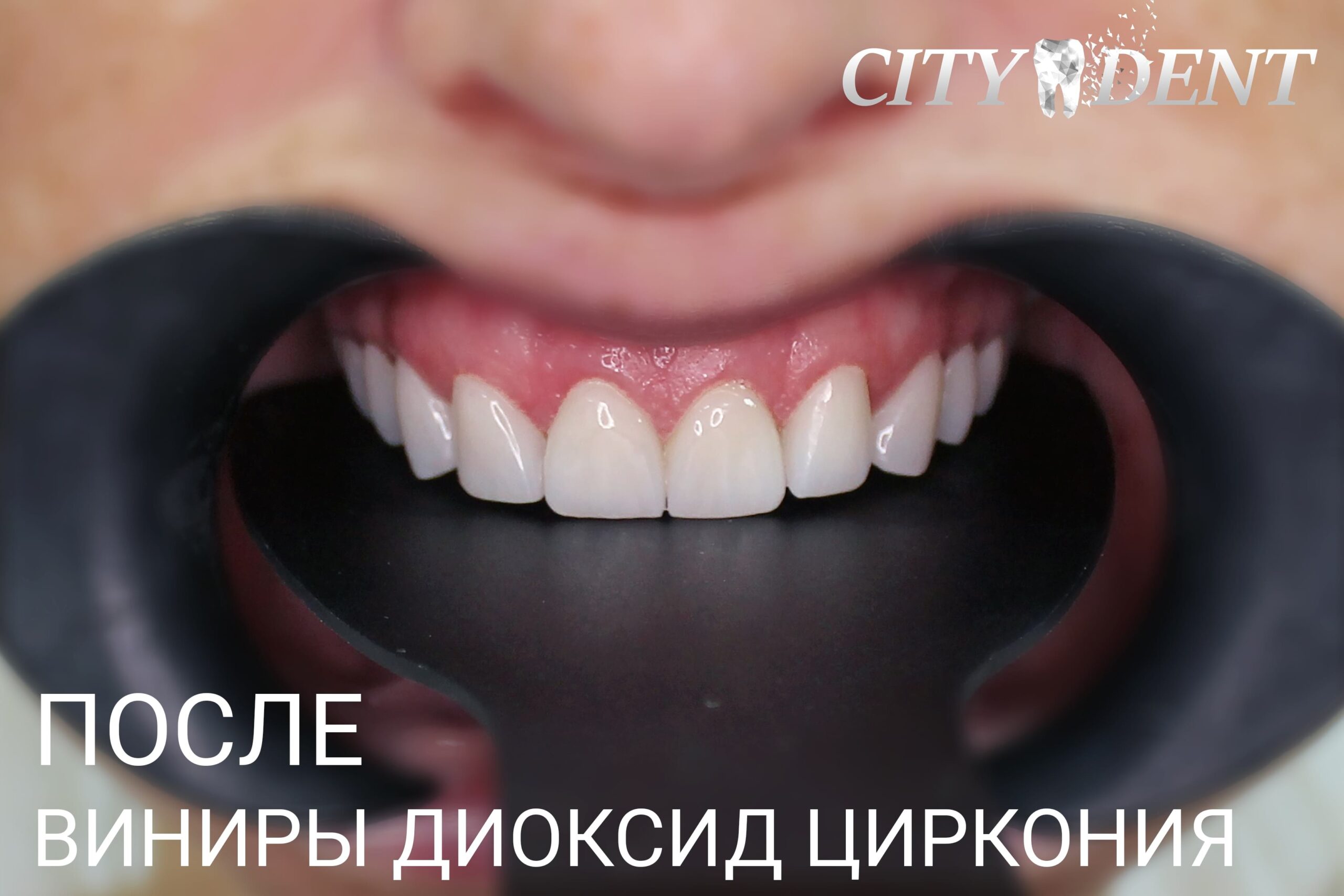 Реставрация после удаления зуба: восстановление улыбки и функциональности