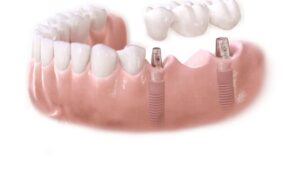 Протезирование на имплантах: рассмотрение использования имплантов в протезировании зубов