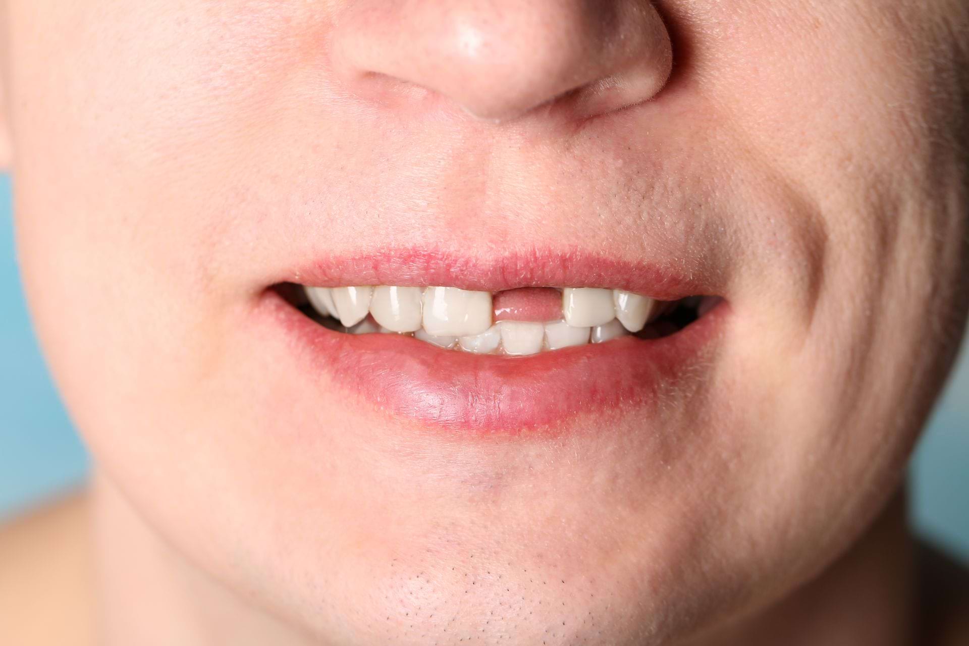 Последствия отсутствия зубных протезов: объяснение проблем, связанных с отсутствием зубных протезов, таких как изменение прикуса, проблемы с жеванием, ухудшение речи и социальные проблем