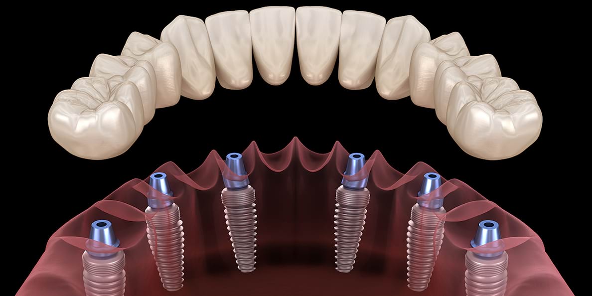 Протезирование на имплантах: рассмотрение использования имплантов в протезировании зубов