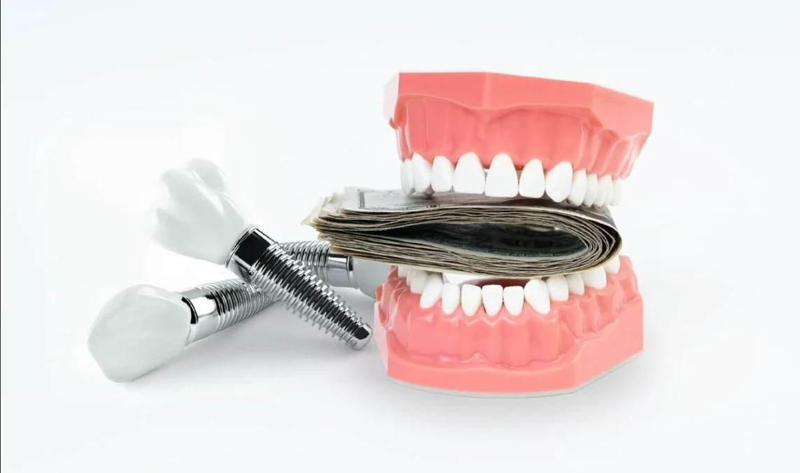 Финансовые аспекты имплантации зубов: обсуждение стоимости имплантации зубов, включая различные факторы, которые могут влиять на цену